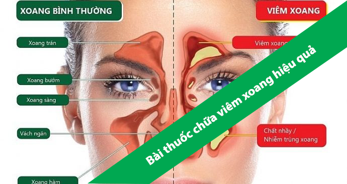 BÀI THUỐC CHỮA VIÊM XOANG HIỆU QUẢ